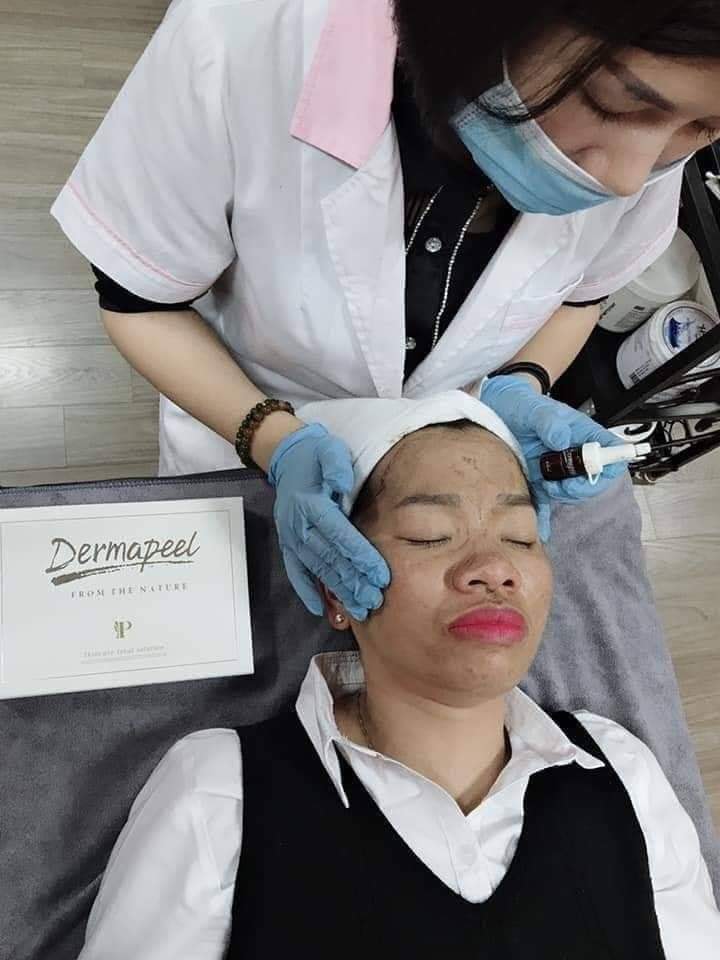 Dermapeel Trứng Cá Tuyết