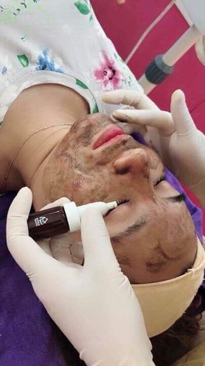 Dermapeel Trứng Cá Tuyết